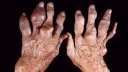 Dấu hiệu bệnh gout ở ngón tay