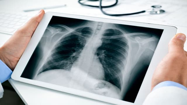 Dấu hiệu bệnh phổi trắng ở người lớn