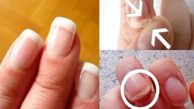 Dấu hiệu bệnh qua móng tay