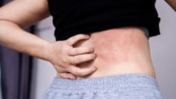 Dấu hiệu bệnh sán chó mèo ở người