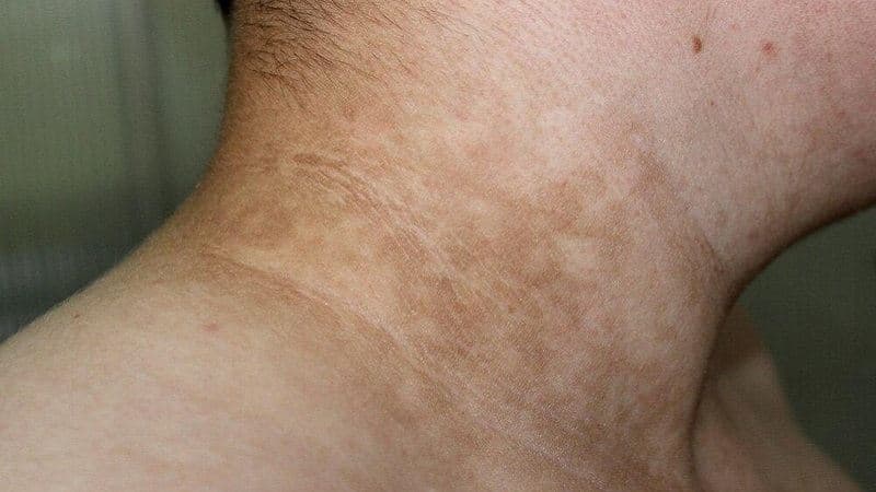 cổ đen dấu hiệu bệnh gì