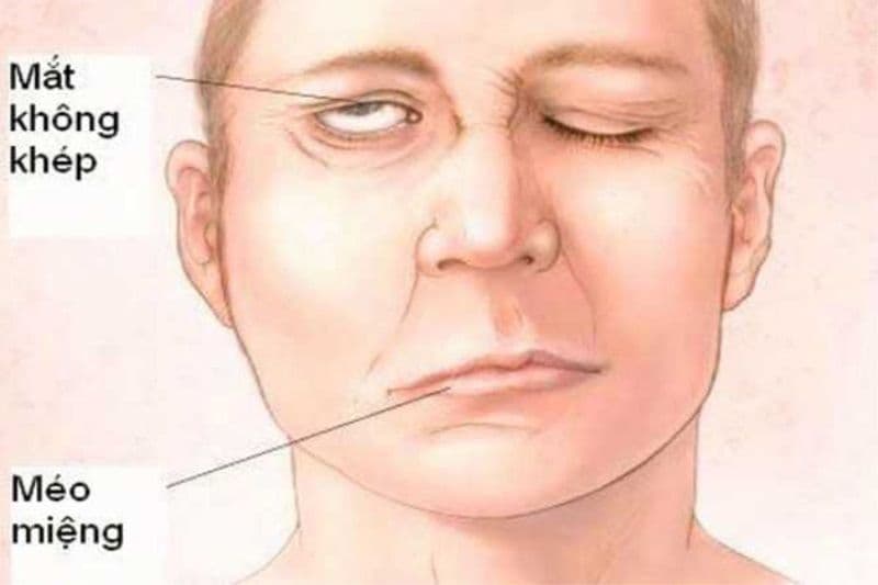 dấu hiệu của bệnh liệt dây thần kinh số 7