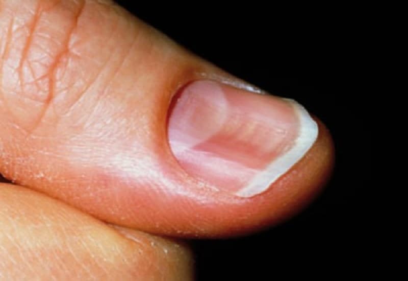 Dấu hiệu bệnh qua móng chân    
