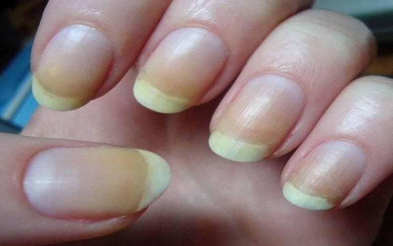 dấu hiệu bệnh qua móng tay