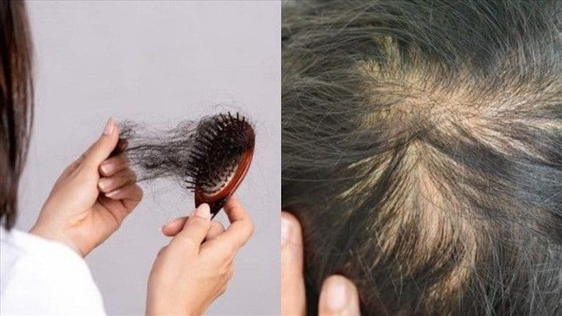 rụng tóc nhiều là dấu hiệu bệnh gì