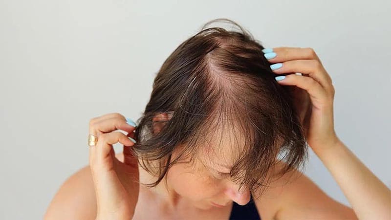 rụng tóc nhiều là dấu hiệu bệnh gì