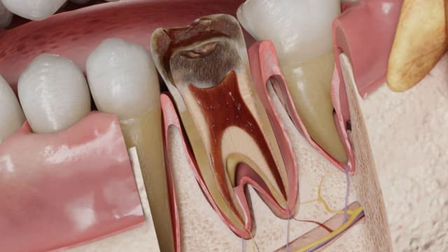 Dấu hiệu sâu răng nặng