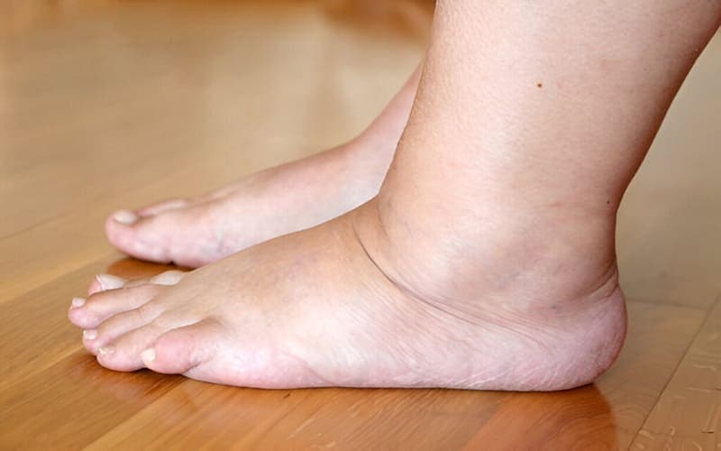 dấu hiệu suy thận giai đoạn đầu ở nữ