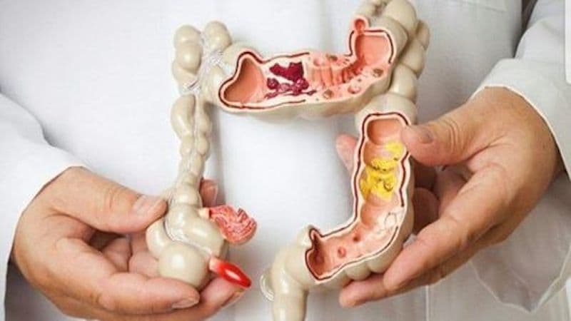 Dấu hiệu của bệnh táo bón nặng