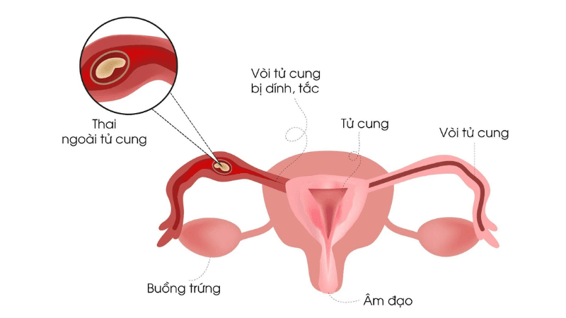 dấu hiệu thai ngoài tử cung tuần 5
