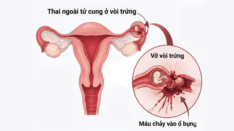 dấu hiệu thai ngoài tử cung tuần 5