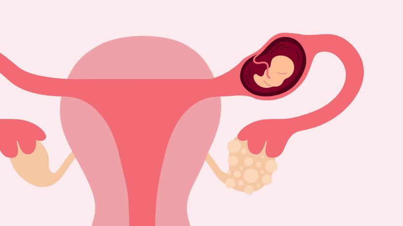 Dấu hiệu thai ngoài tử cung tuần 5