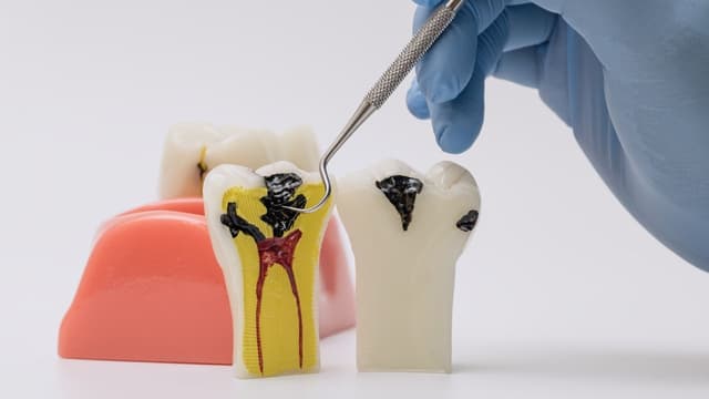Điều trị răng sâu vào tủy có đau không?