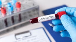 Định lượng D-dimer là gì và vai trò trong tầm soát đột quỵ