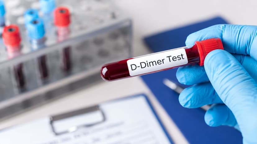 Định lượng D-dimer là gì và vai trò trong tầm soát đột quỵ