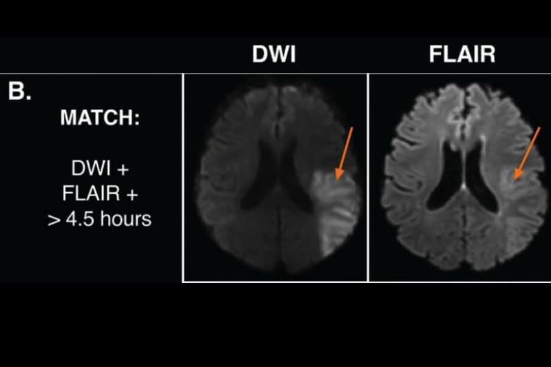 các giai đoạn nhồi máu não trên mri