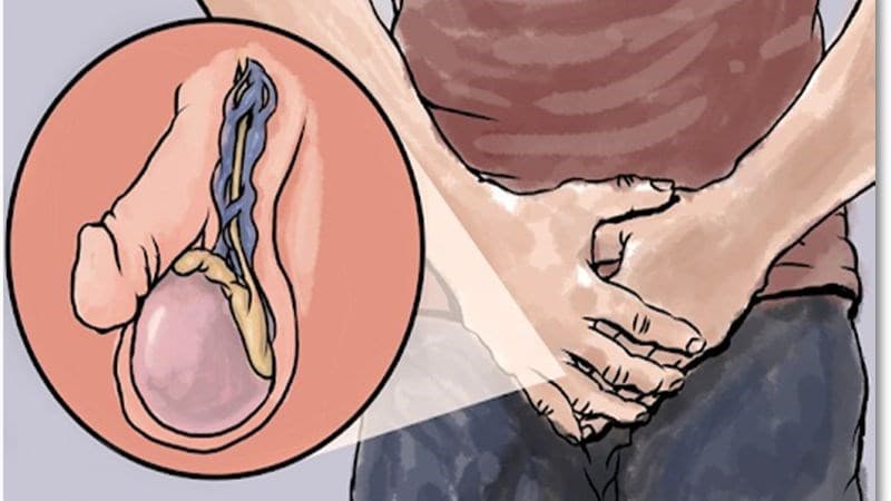 giãn tĩnh mạch thừng tinh 2 bên