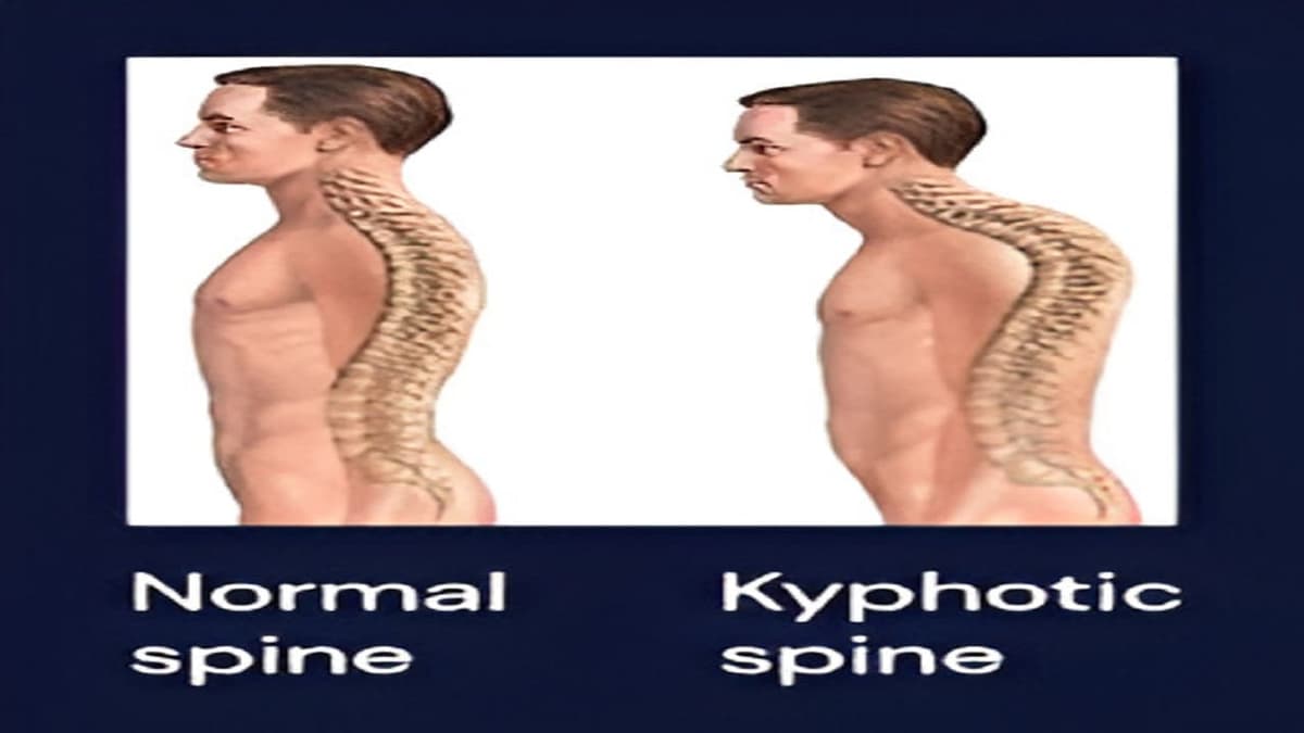 Gù lưng có di truyền không?