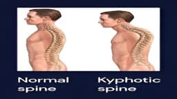 Gù lưng có di truyền không?