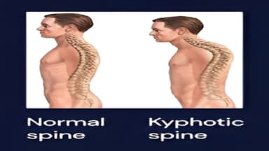 Gù lưng có di truyền không?