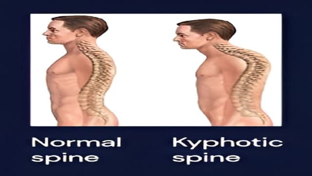 Gù lưng có di truyền không?