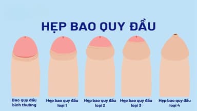 Hẹp bao quy đầu là gì? Dấu hiệu nhận biết ở người lớn và trẻ em