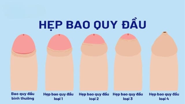 Hẹp bao quy đầu là gì? Dấu hiệu nhận biết ở người lớn và trẻ em