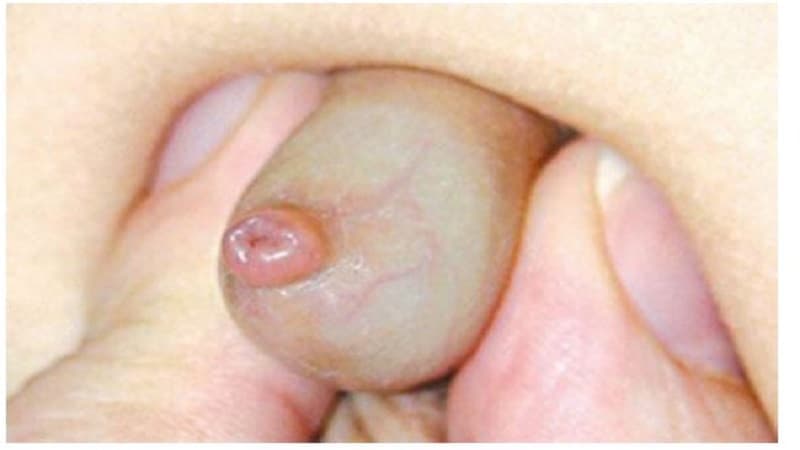 bao quy đầu trẻ em bình thường