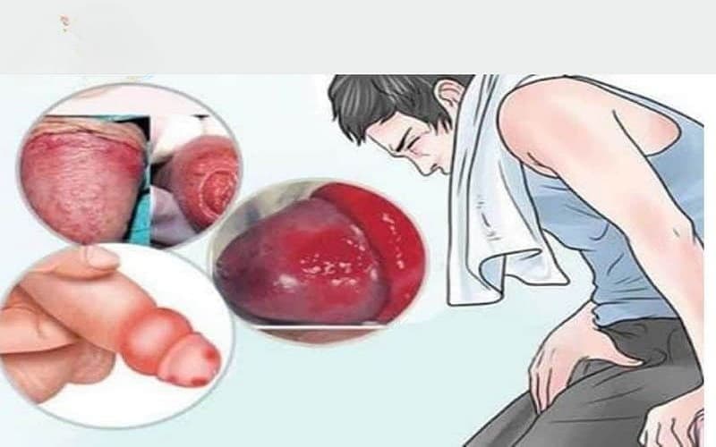 sau khi cắt bao quy đầu