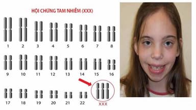 Hội chứng siêu nữ là gì? Có nguy hiểm không?