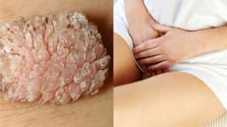 Gợi ý địa chỉ khám sùi mào gà ở Linh Đàm uy tín
