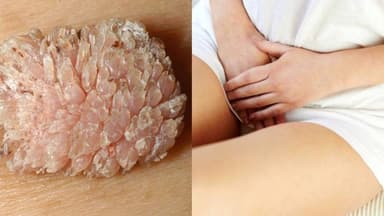 Gợi ý địa chỉ khám sùi mào gà ở Linh Đàm uy tín