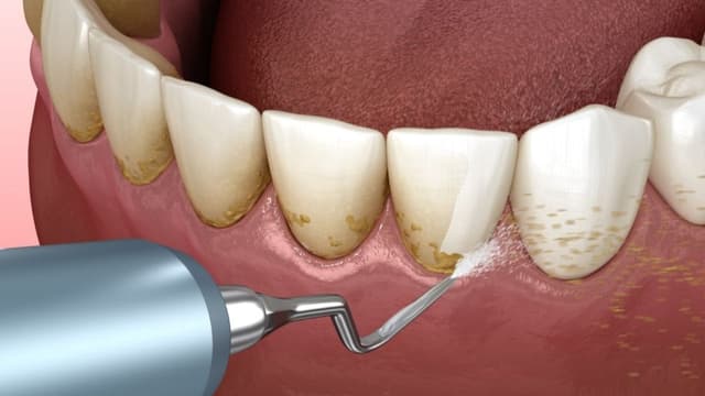 Lấy cao răng có tốt không?