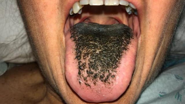 Lưỡi bị đen là dấu hiệu bệnh gì?
