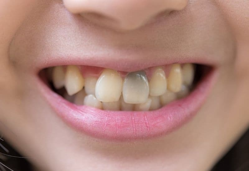 Men răng bị đen có chữa được không?