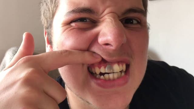 Men răng bị đen có chữa được không?