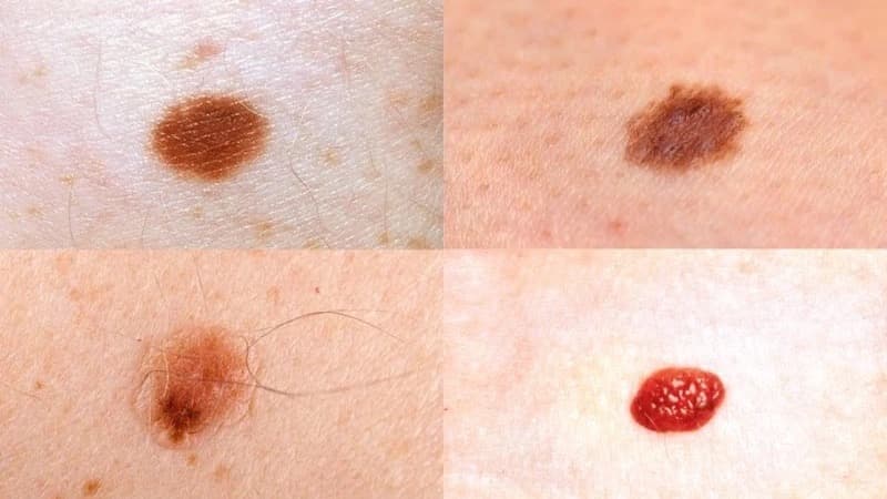 nốt ruồi đỏ mọc nhiều là dấu hiệu bệnh gì