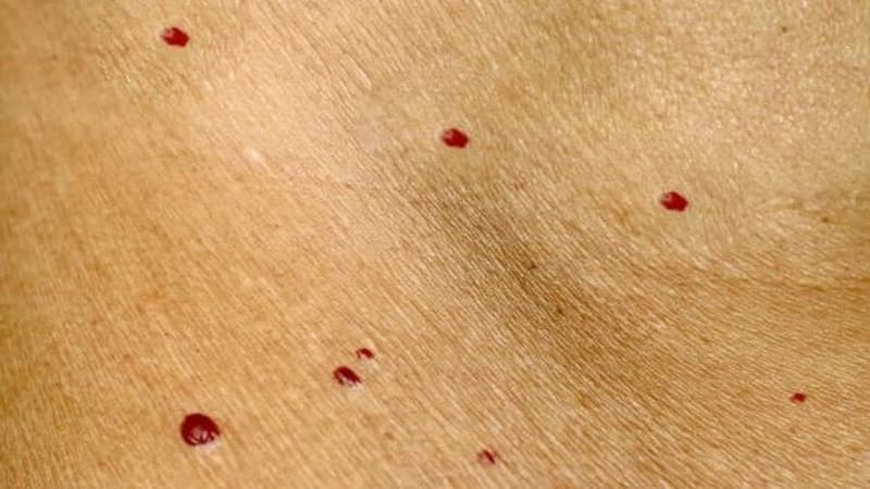 nốt ruồi đỏ mọc nhiều là dấu hiệu bệnh gì