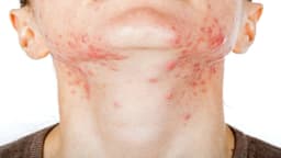 Mụn nội tiết nam: Nguyên nhân và các cách điều trị hiệu quả tận gốc