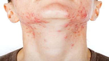 Mụn nội tiết nam: Nguyên nhân và các cách điều trị hiệu quả tận gốc