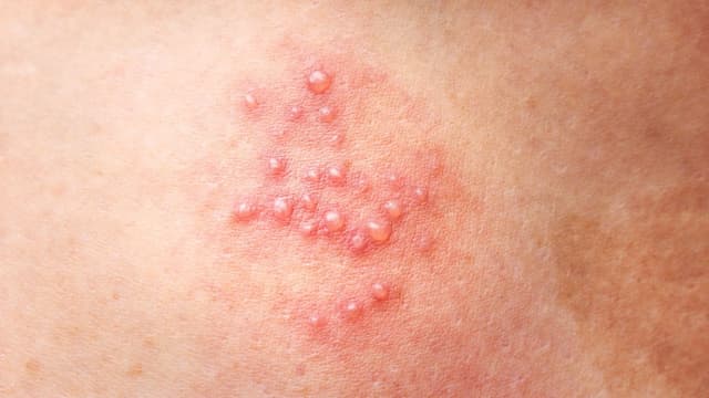 Mụn rộp sinh dục nữ có tự hết không?