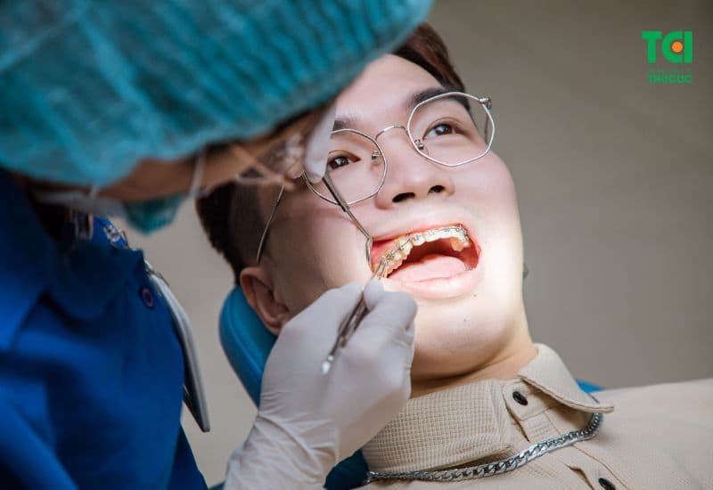 Nhổ răng bao lâu thì kéo khoảng?