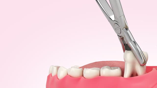 Nhổ răng bao lâu thì kéo khoảng?