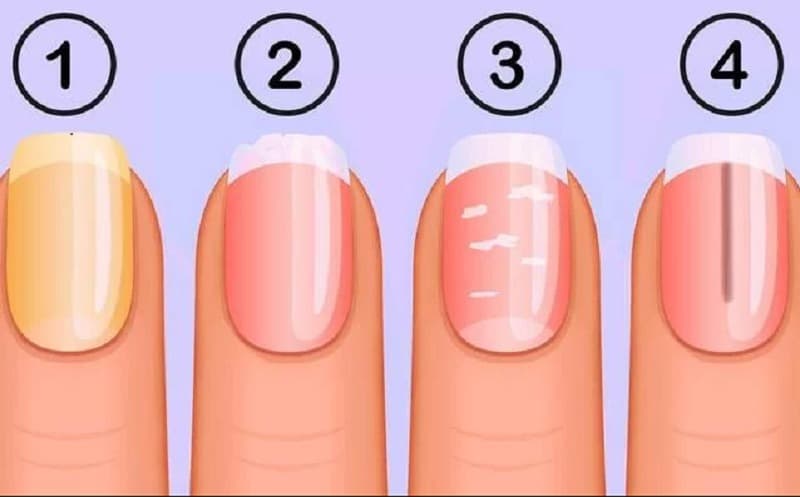 dấu hiệu bệnh qua móng tay