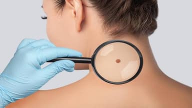 Nốt ruồi đỏ mọc nhiều là dấu hiệu bệnh gì