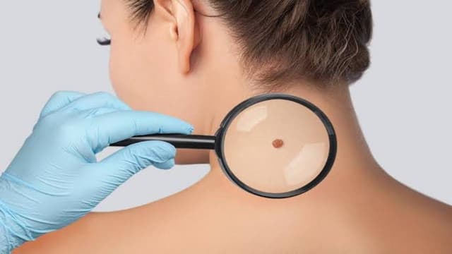 Nốt ruồi đỏ mọc nhiều là dấu hiệu bệnh gì