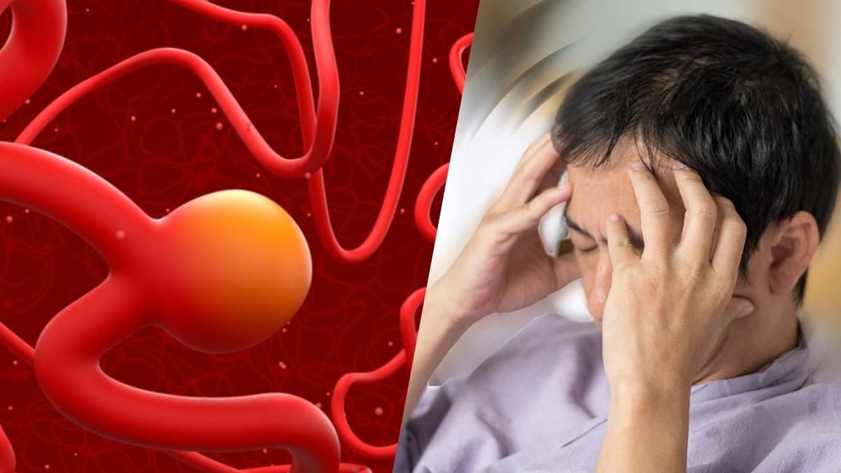 Phình động mạch não có nguy hiểm không?