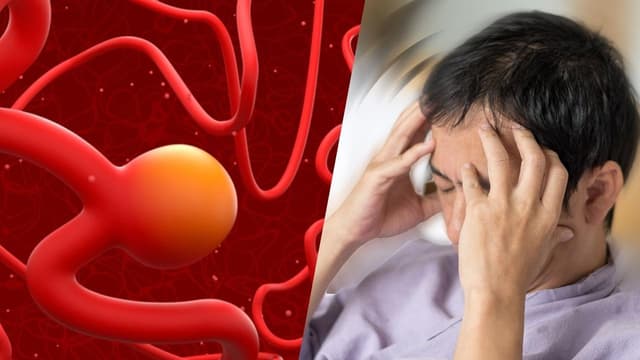 Phình động mạch não có nguy hiểm không?