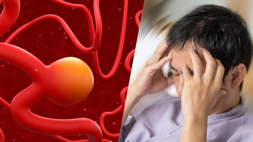 Phình động mạch não có nguy hiểm không?