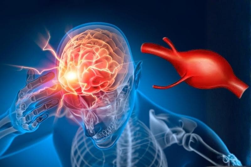 Phình động mạch não có nguy hiểm không?